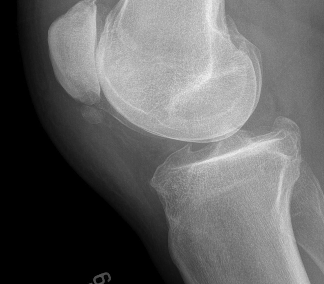 Patella Tendon Calcification